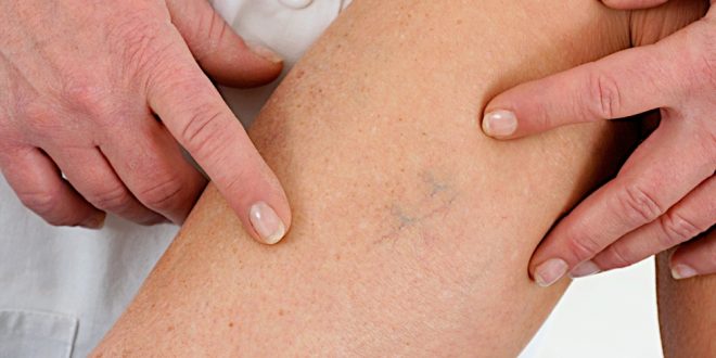 Varicose and Spider Veins Treatment